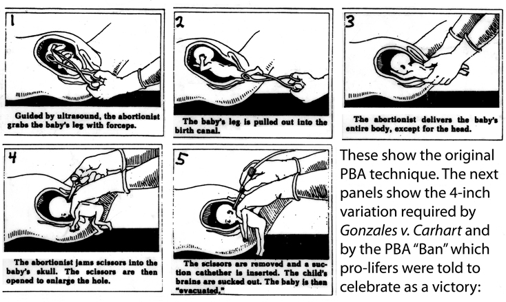 Original partial-birth abortion (PBA) diagrams