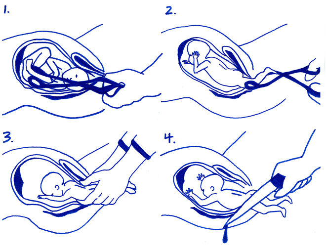 New partial-birth abortion technique (PBA ban's 4-inch variation)